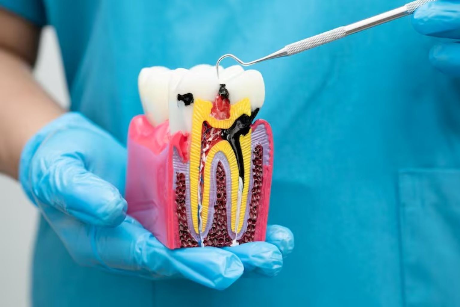 How Root Canals Help Save Natural Teeth from Extraction