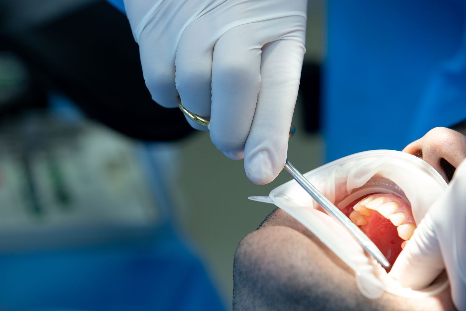 Signs You Might Need a Tooth Extraction